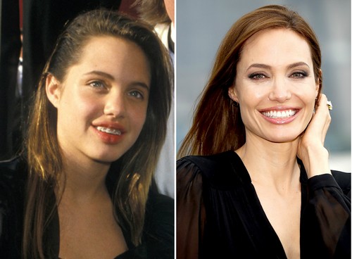 Angelina Jolie with Braces