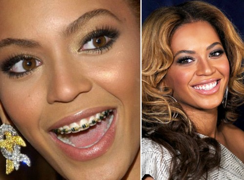 Beyoncee Famous Actresses with Braces 