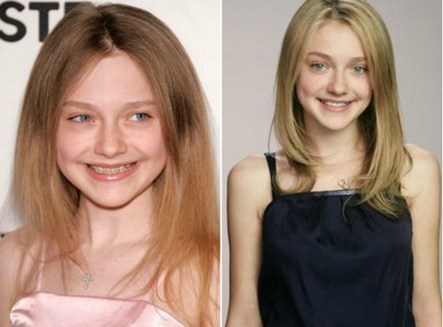 Dakota Fanning with Braces