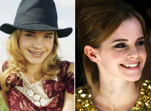 Emma Watson Famous Actresses with Braces 