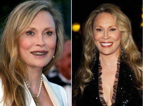 Faye Dunaway Famous Actresses with Braces 