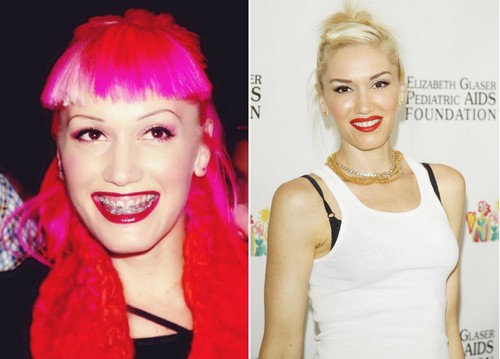 Gwen Stefani Famous Actresses with Braces 
