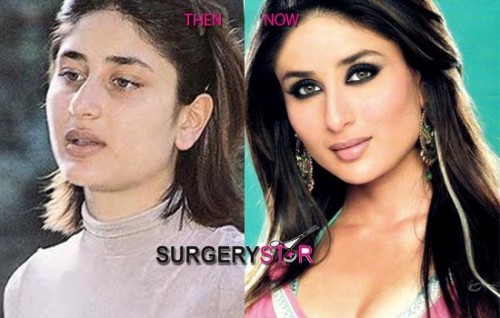 Bollywood Actresses Who Went Through Plastic Surgery