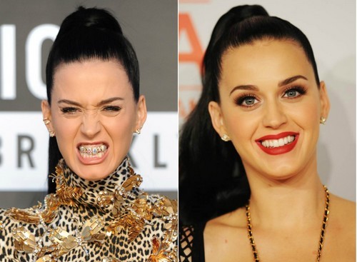 Katy Perry with Braces