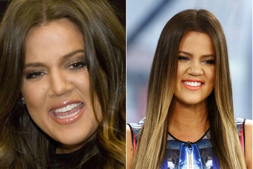 Khloe Kardashian with Braces