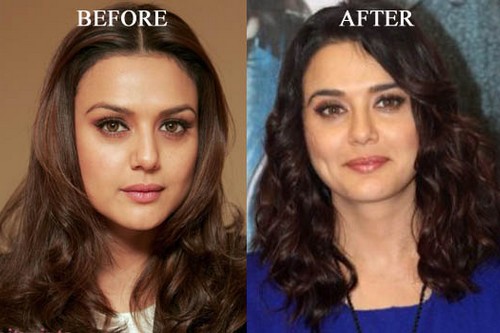 Bollywood Actresses Who Went Through Plastic Surgery