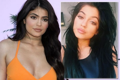 Kylie Jenner Lip Injections 